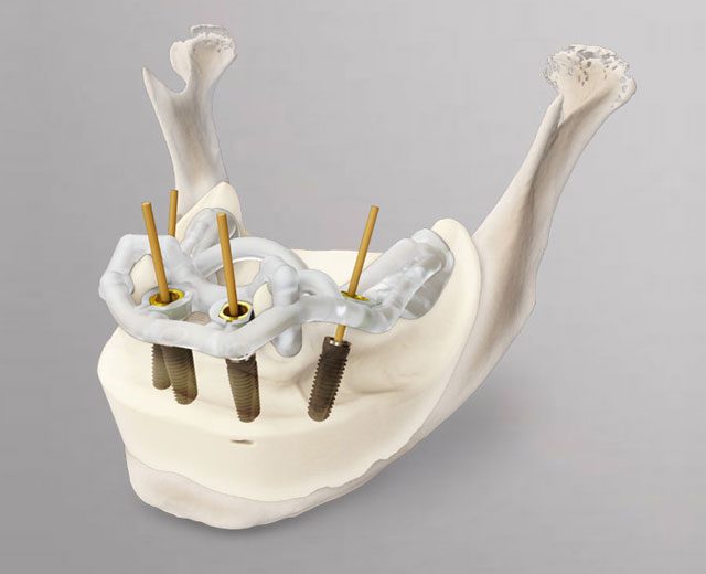 triadent-mitte-navigierte-implantologie-5