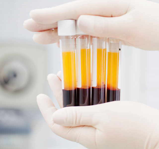 triadent-mitte-prf-prp-eigenbluttherapie-1