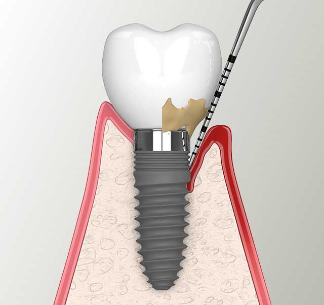triadent-mitte-periimplantitis